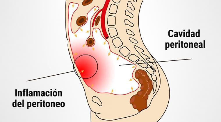 Peritonitis