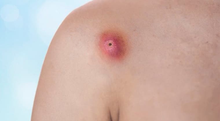 Abscesos cutáneos o intraabdominales