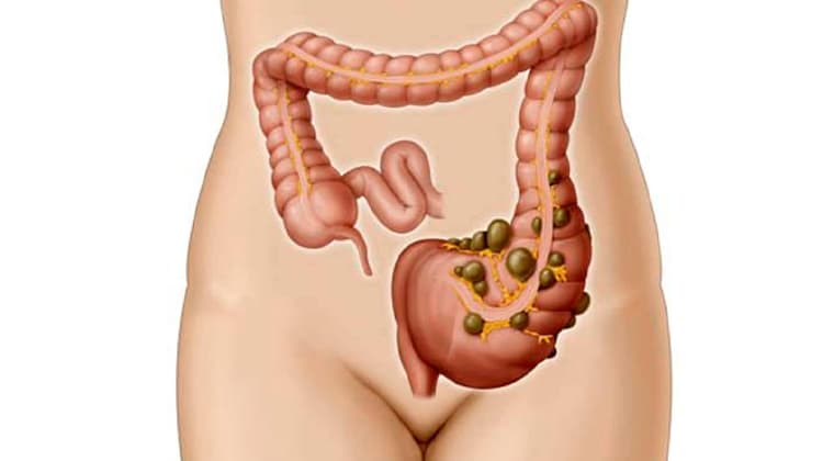Enfermedad diverticular del colon