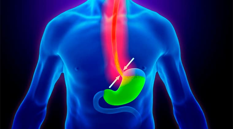 Enfermedad por reflujo gastroesofágico (ERGE)