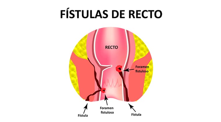 Hemorroides, fístulas y fisuras anales