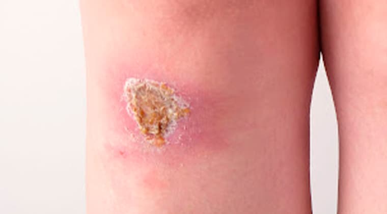 Heridas infectadas (Agudas y crónicas)