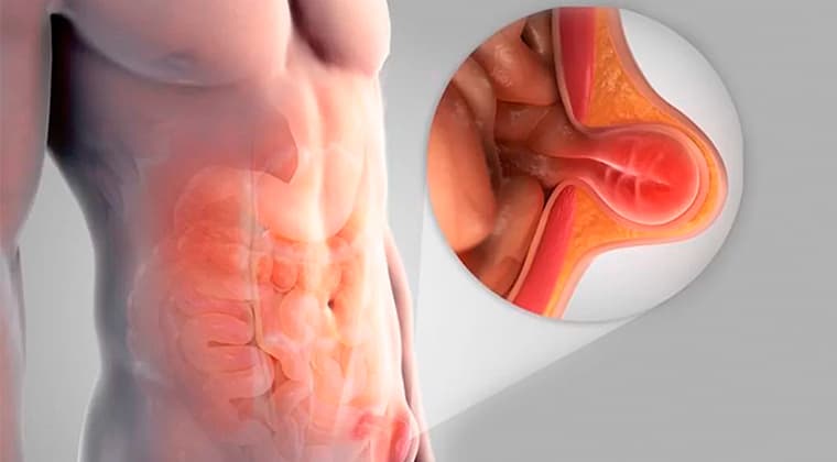 Hernias (Inguinal, umbilical, hiatal)