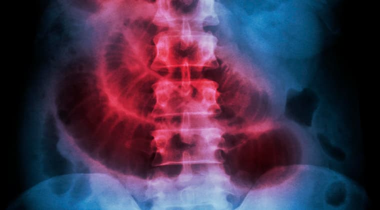 Obstrucción intestinal