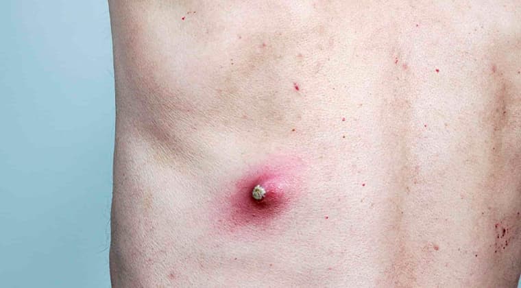 Quistes sebáceos o lipomas