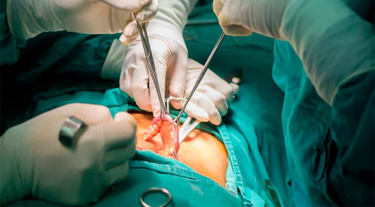 Cirugía de apendicitis (Apendicectomía laparoscópica y/o abierta)