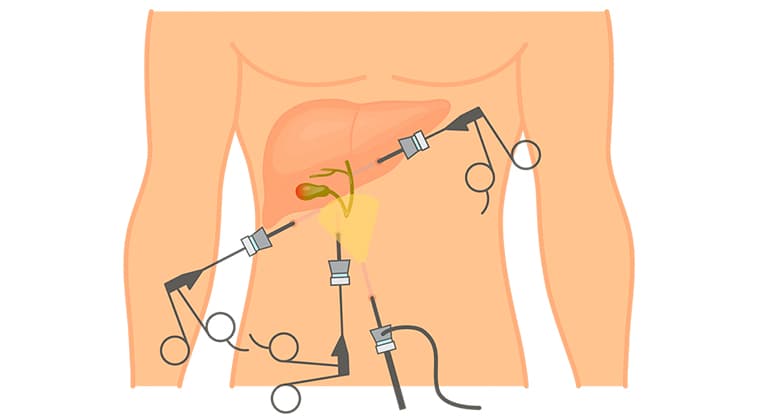 Cirugía de vesícula biliar (Colecistectomía laparoscópica y/o abierta)