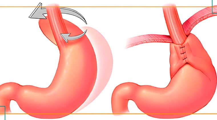 Corrección quirúrgica de reflujo gastroesofágico (Funduplicatura laparoscópica)