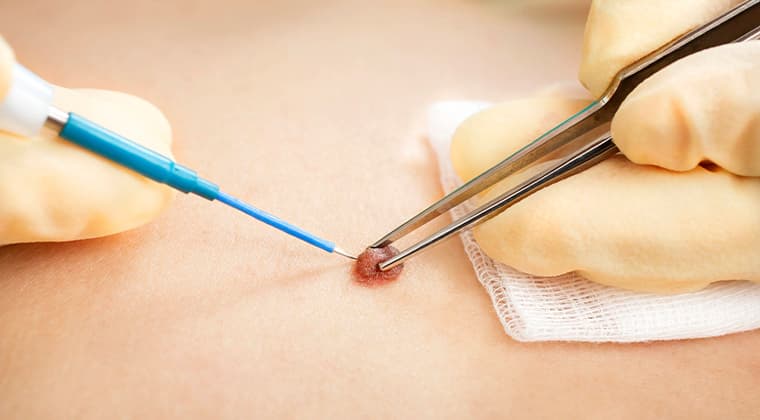 Resección de tumores benignos y malignos de piel