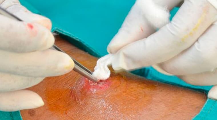 Tratamiento quirúrgico de quistes