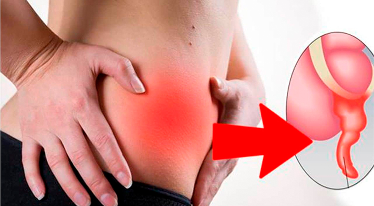 Apendicitis aguda