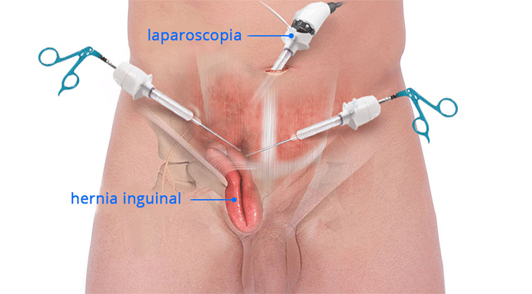 Reparación de hernias (Inguinal, umbilical, hiatal, etc.)